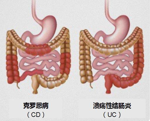 5月19日是世界炎症性腸病日，醫患攜手，健康“腸”在